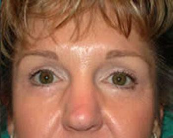 After Results for Eyelid Surgery