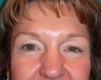 Before Results for Eyelid Surgery