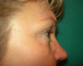 Before Results for Eyelid Surgery