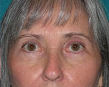 After Results for Eyelid Surgery
