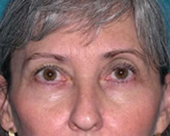 Before Results for Eyelid Surgery