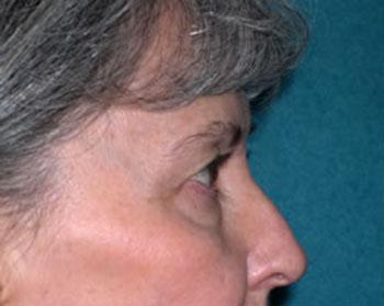 Before Results for Eyelid Surgery