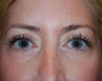 After Results for Eyelid Surgery