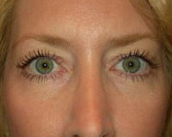 Before Results for Eyelid Surgery