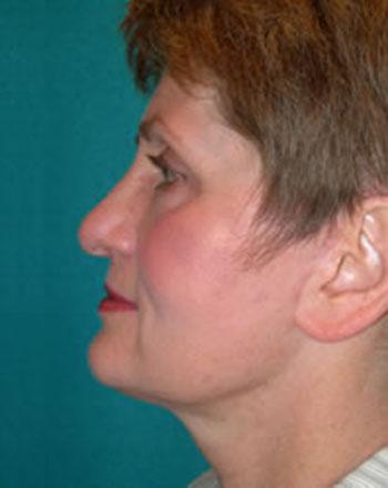 After Results for Facelift