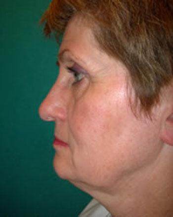 Before Results for Facelift