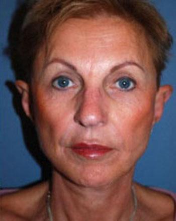 After Results for Facelift