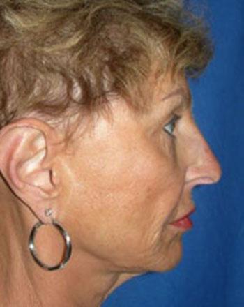 Before Results for Facelift