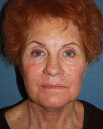 After Results for Facelift