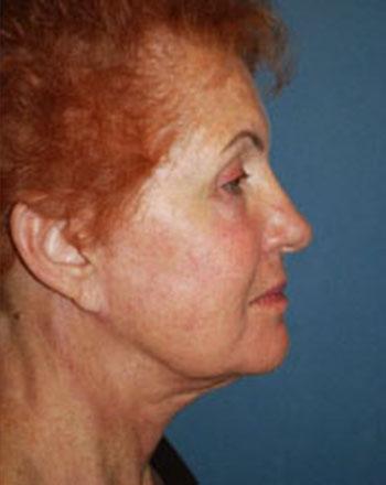 After Results for Facelift