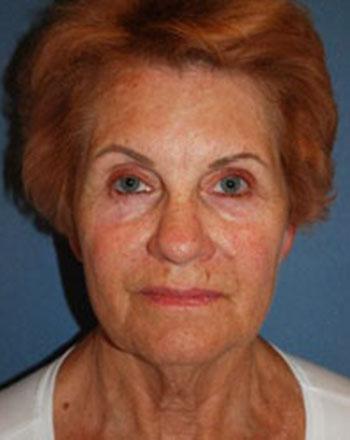 Before Results for Facelift