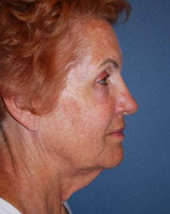 Before Results for Facelift