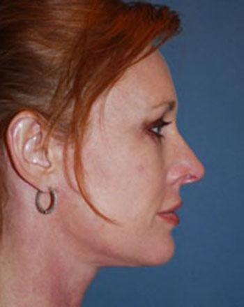 After Results for Facelift