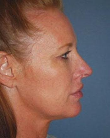 Before Results for Facelift