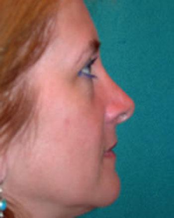 After Results for Rhinoplasty