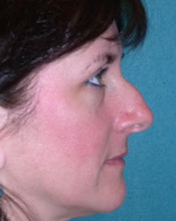 Before Results for Rhinoplasty