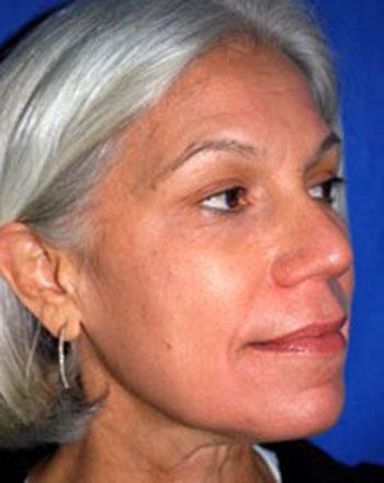 After Results for Laser Skin Resurfacing