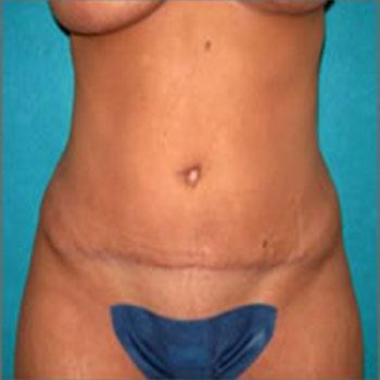 After Results for Tummy Tuck