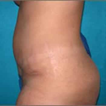 After Results for Tummy Tuck