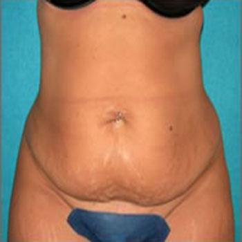 Before Results for Tummy Tuck