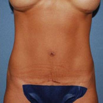 After Results for Tummy Tuck