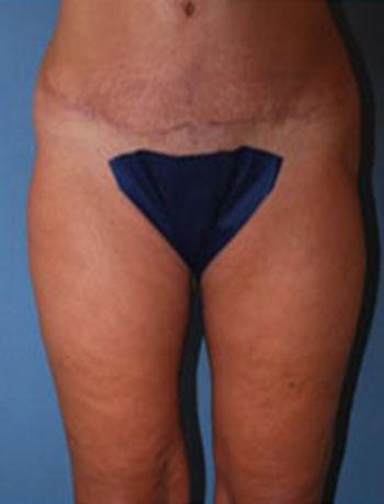 After Results for Thigh Lift