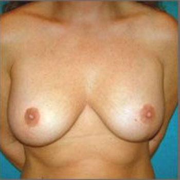 After Results for Breast Augmentation