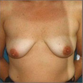 Before Results for Breast Augmentation