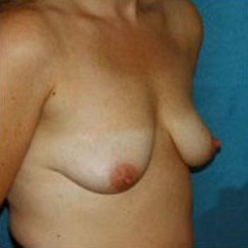 Before Results for Breast Augmentation