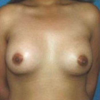 After Results for Breast Augmentation