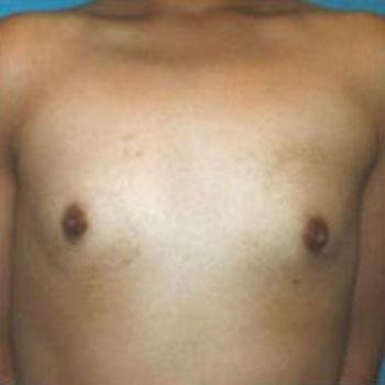 Before Results for Breast Augmentation