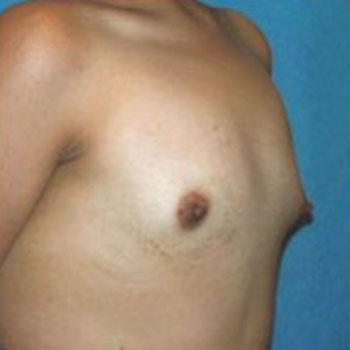 Before Results for Breast Augmentation