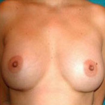 After Results for Breast Augmentation