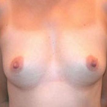 Before Results for Breast Augmentation