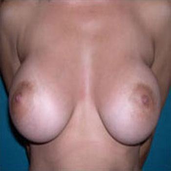 After Results for Breast Augmentation