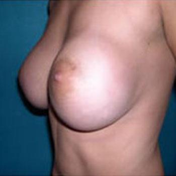 After Results for Breast Augmentation