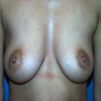 Before Results for Breast Augmentation