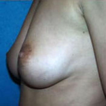 Before Results for Breast Augmentation