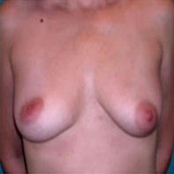 Before Results for Breast Augmentation