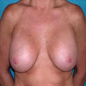 After Results for Breast Augmentation