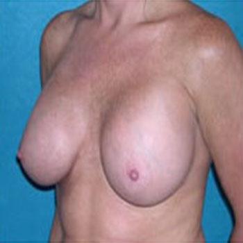 After Results for Breast Augmentation