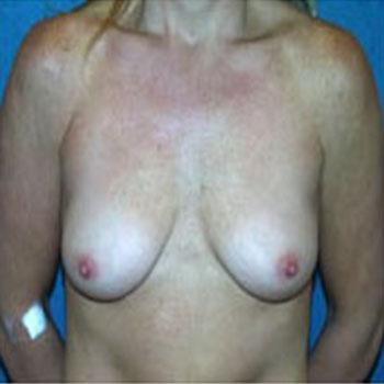 Before Results for Breast Augmentation