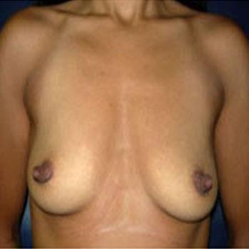 Before Results for Breast Augmentation