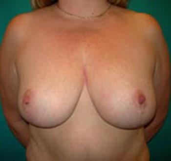 After Results for Breast Reduction