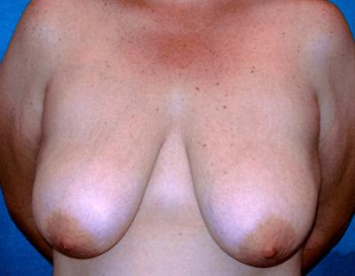 Before Results for Breast Lift