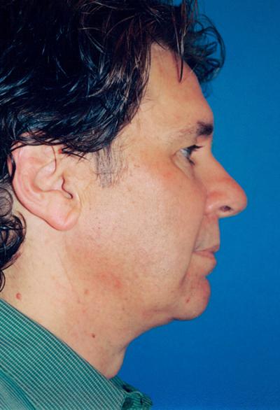 After Results for Chin Augmentation