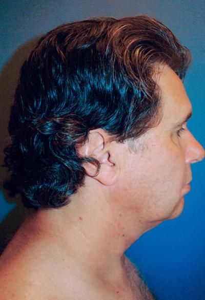 Before Results for Chin Augmentation