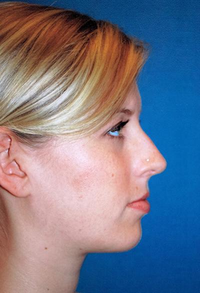 After Results for Chin Augmentation