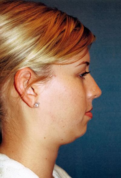 Before Results for Chin Augmentation