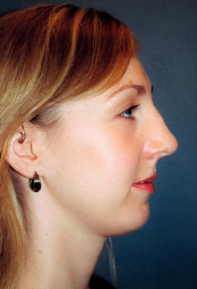 Before Results for Chin Augmentation